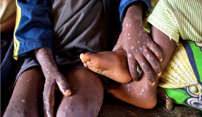 تسجيل 1267 حالة وفاة بجدري القردة في الكونغو الديمقراطية