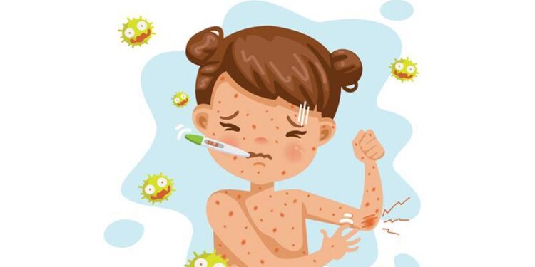 مرض الحصبة.. طرق انتقال العدوى والوقاية