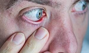 استشاري قلب يحذر: ارتفاع ضغط الدم قد يسبب نزيفًا في العين