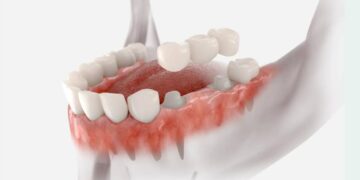 الذكاء الاصطناعي في طب الأسنان الترميمي