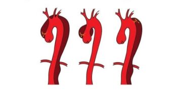 تجمع نجران الصحي ينجح في إنقاد حياة مريضة بعد تسلخ الشريان الأورطي