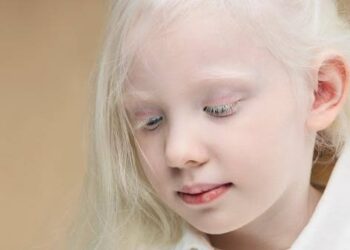 تجمع الرياض الصحي الثاني: ‏قلة أو انعدام صبغة الميلانين تسبب المهق