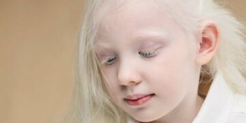 تجمع الرياض الصحي الثاني: ‏قلة أو انعدام صبغة الميلانين تسبب المهق