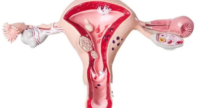استشاري: ألياف الرحم من أكثر الأورام شيوعا عند النساء من سن 20 إلى 40 سنة