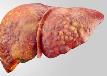 استشاري: تراكم الدهون في الكبد أحد أسباب تدهور وظائفه
