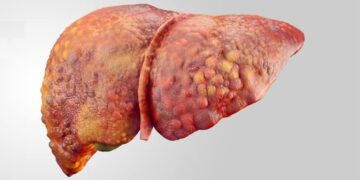 استشاري: تراكم الدهون في الكبد أحد أسباب تدهور وظائفه