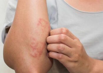 دراسة: التلوث قد يقي من سرطان الجلد ولكن الثمن غالٍ