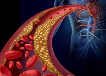 أستاذ طب باطني يحذر: تصلب الشرايين سبب رئيسي لجلطات المخ ويدعو للوقاية المبكرة