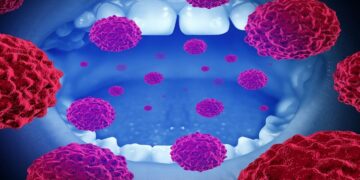 باحثون يكشفون كيف تتحول الخلايا السليمة إلى خلايا سرطانية في الفم بسرعة قياسية (إنفو جرافيك)