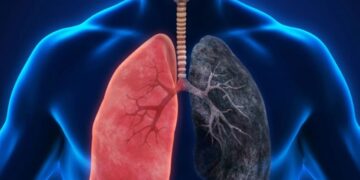 ارتفاع حالات سرطان الرئة بين غير المدخنين يثير قلق الباحثين (إنفو جرافيك)