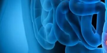 استشاري يوضح اسباب وعلاج قرحة القولون