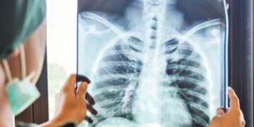 «محاصرته والقضاء عليه».. الصحة العالمية تحتفي باليوم العالمي لمكافحة السل