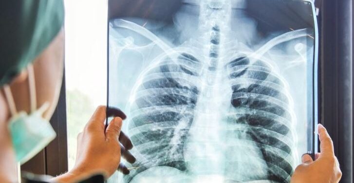 «محاصرته والقضاء عليه».. الصحة العالمية تحتفي باليوم العالمي لمكافحة السل