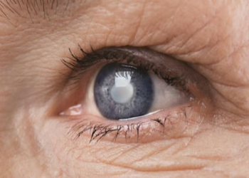 احذر “سارق البصر الصامت”.. 4 أسئلة بسيطة قد تنقذ عينيك من الجلوكوما