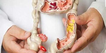 أعراض لا تتجاهلها.. قد تكون مؤشرًا لسرطان القولون والمستقيم