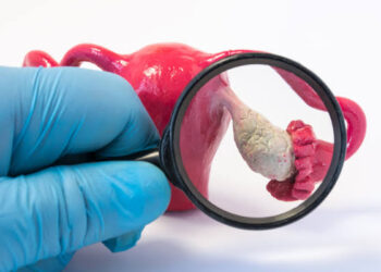 التشخيص المبكر يقلل خطورته.. أطباء يحذّرون من الأعراض الصامتة لسرطان المبيض