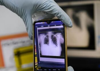 26 %.. قفزة مقلقة في إصابة أطفال أوروبا بمرض السل