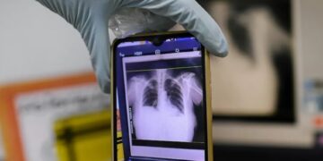 26 %.. قفزة مقلقة في إصابة أطفال أوروبا بمرض السل