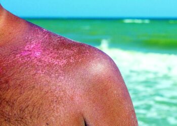 5 نصائح ذهبية للوقاية من سرطان الجلد