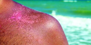 5 نصائح ذهبية للوقاية من سرطان الجلد