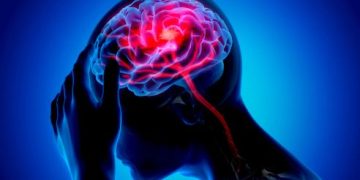 علاج السكتات الدماغية