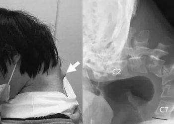 شاب يفقد القدرة على رفع رأسه بسبب الهاتف.. قصة تحذيرية من متلازمة نادرة