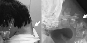 شاب يفقد القدرة على رفع رأسه بسبب الهاتف.. قصة تحذيرية من متلازمة نادرة