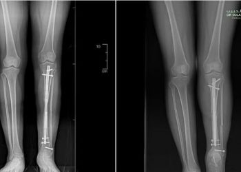 عملية تطويل عظام مبتكرة