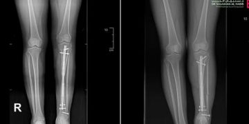 عملية تطويل عظام مبتكرة