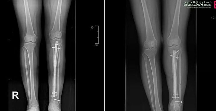 عملية تطويل عظام مبتكرة