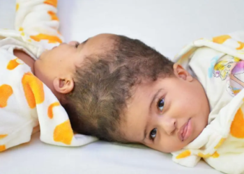 فصل توأم بعد جراحة معقدة