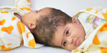 فصل توأم بعد جراحة معقدة