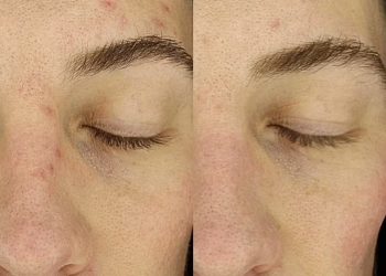 كميائي حائز على نوبل يخترع قناع ثوري للتجميل