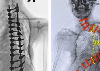 نجاح عملية معقدة لطفلة تعاني من انحراف حاد بالعمود الفقري بمستشفى الدكتور سليمان الحبيب