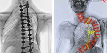 نجاح عملية معقدة لطفلة تعاني من انحراف حاد بالعمود الفقري بمستشفى الدكتور سليمان الحبيب