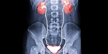 سابقة تاريخية في الطب.. نجاح عملية زرع مثانة بشرية لمريض