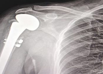 نجاح جراحة دقيقة لاستبدال مفصل الكتف بمدينة الملك سلمان الطبية بالمدينة المنورة