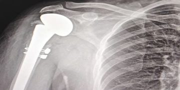 نجاح جراحة دقيقة لاستبدال مفصل الكتف بمدينة الملك سلمان الطبية بالمدينة المنورة