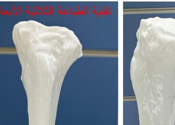 بأيدٍ سعودية وبتقنية الطباعة ثلاثية الأبعاد..  نجاح باهر لعملية تصحيح انحراف شديد في الركبة بمستشفى الملك فهد الجامعي