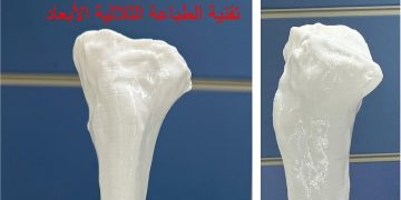 بأيدٍ سعودية وبتقنية الطباعة ثلاثية الأبعاد..  نجاح باهر لعملية تصحيح انحراف شديد في الركبة بمستشفى الملك فهد الجامعي