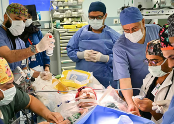 فصل التوأم السيامي