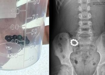 مستشفى الدكتور سليمان الحبيب بالصحافة ينقذ حياة طفل ابتلع 10 كرات مغناطيسية تسببت في تلف الأمعاء