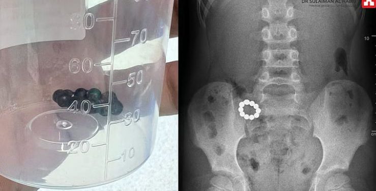 مستشفى الدكتور سليمان الحبيب بالصحافة ينقذ حياة طفل ابتلع 10 كرات مغناطيسية تسببت في تلف الأمعاء