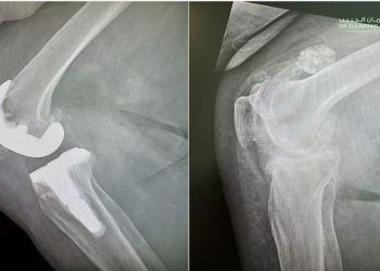 إنجاز طبي في السعودية.. مستشفى‎ الدكتور سليمان الحبيب يعيد الحركة لثمانينية بعملية استبدال مفصل ركبة
