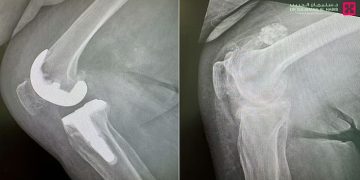 إنجاز طبي في السعودية.. مستشفى‎ الدكتور سليمان الحبيب يعيد الحركة لثمانينية بعملية استبدال مفصل ركبة