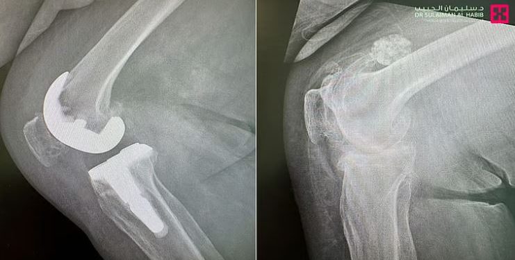 إنجاز طبي في السعودية.. مستشفى الدكتور سليمان الحبيب يعيد الحركة لثمانينية بعملية استبدال مفصل ركبة