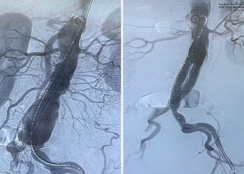 عملية دقيقة تنهي معاناة سبعيني من تمدد الشريان الأورطي وتصلب الشرايين في جدة