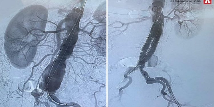 عملية دقيقة تنهي معاناة سبعيني من تمدد الشريان الأورطي وتصلب الشرايين في جدة
