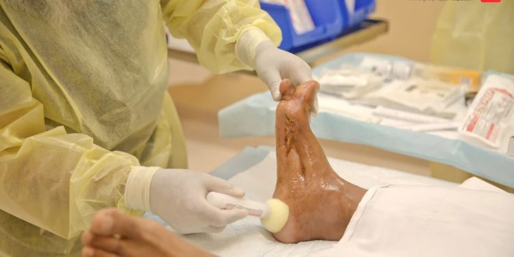 أمل جديد لآلاف المرضى.. مستشفى دكتور سليمان الحبيب يُطلق مركزاً لعلاج “القدم السكرية والجروح المزمنة”