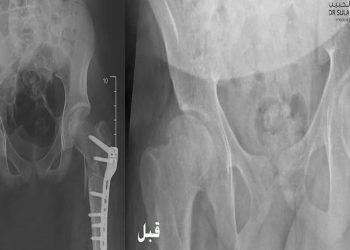 إنجاز طبي بمستشفى الدكتور سليمان الحبيب بالخبر يعيد القدرة على المشي لشاب بعد معاناة 10 سنوات